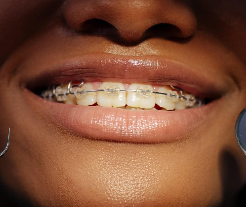 Close-up of a smiling person with clear braces on their teeth, highlighting dental orthodontic treatment. Only the mouth and part of the face are visible.