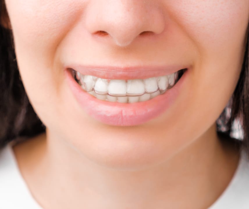 A close-up of a smiling person wearing clear dental aligners, showing straight teeth and natural lips, with a partial view of their cheeks.