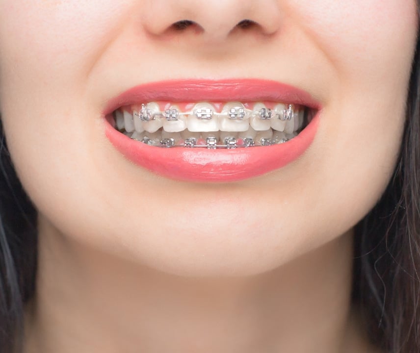 A close-up of a person smiling, showing teeth with braces and lips with red lipstick, no recognizable landmarks or historical buildings in the image.